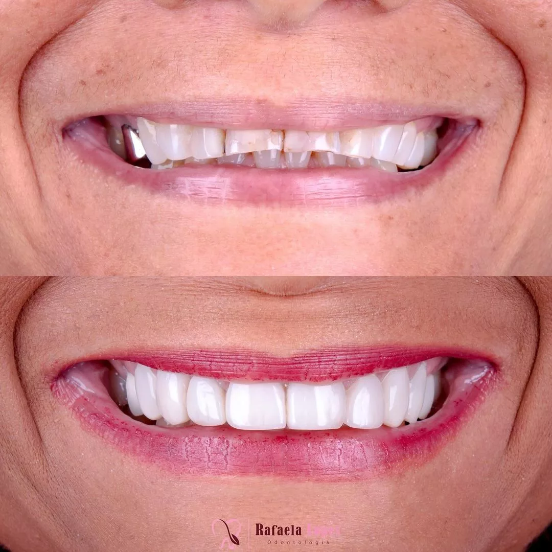 antes e depois de lentes de resina no sorriso completo — Dra. Rafaela Lopes
