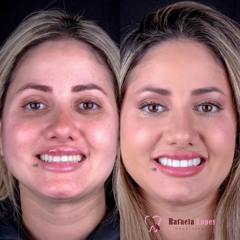 loira_antes_depois_perfil_frontal