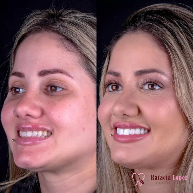 loira_antes_depois_perfil_lateral