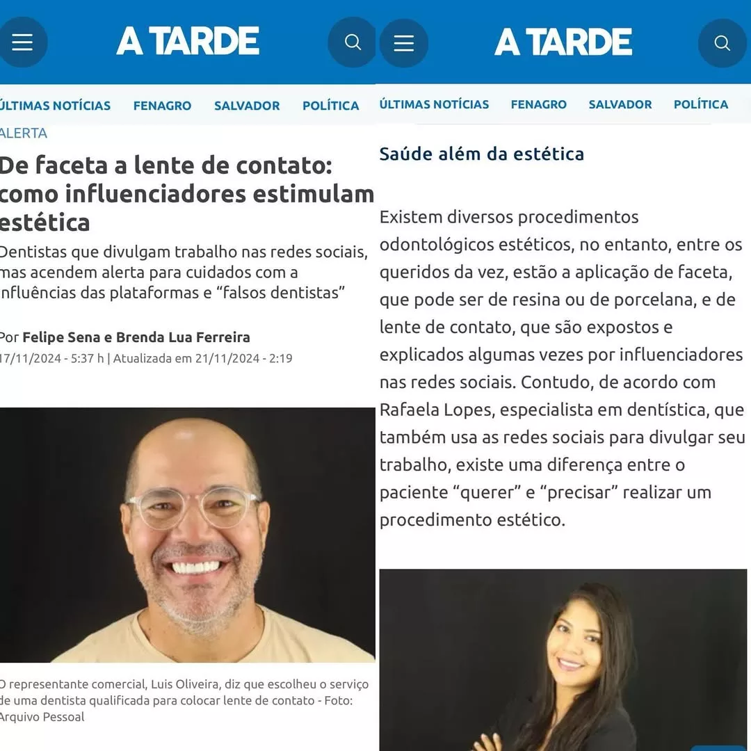 Dra. Rafaela Lopes em matéria do jornal A Tarde sobre lentes de contato dental