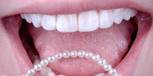 sorriso com lentes de resina estratificada — consultório em Alphaville, Salvador