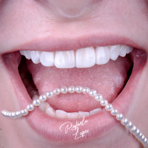 sorriso com lentes de resina estratificada — consultório em Alphaville, Salvador