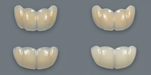 Lentes de Resina ou Porcelana