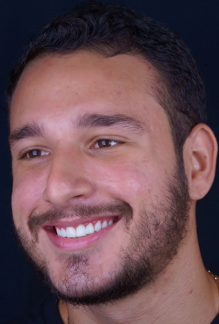 joao-lente de resina em salvador